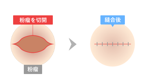粉瘤を切開→縫合後
