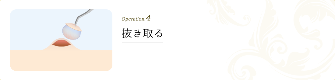 operation.4 抜き取る