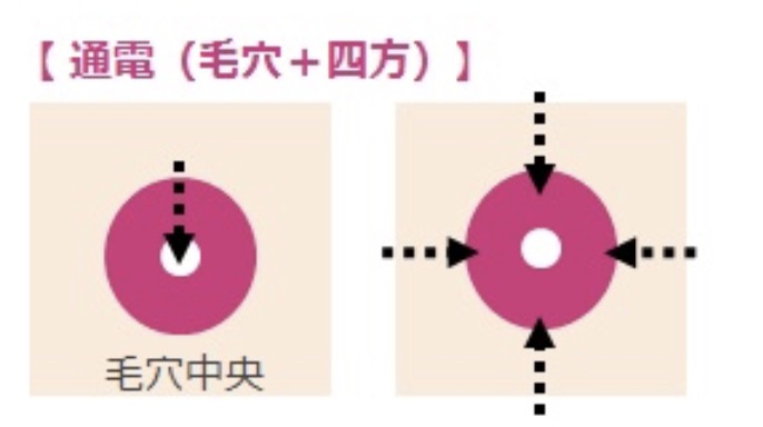 アグネスは微細絶縁針を皮脂腺に刺し、高周波を皮脂腺のみに流し、皮脂腺のみを破壊する機械です。絶縁針を使うので、皮膚表面にやけどを起こすことなく皮脂腺のみ破壊することが出来るようになっています。