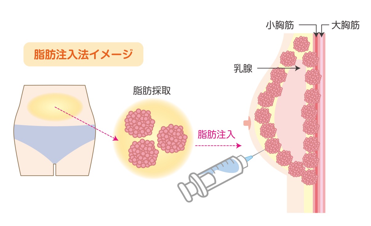 自己組織による豊胸