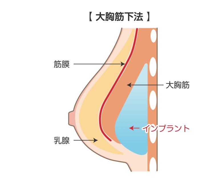 インプラントによる豊胸