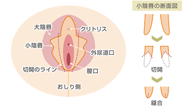小陰唇縮小手術