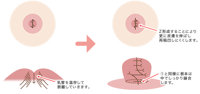 中程度の場合