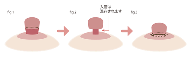 下垂乳頭修正手術の方法