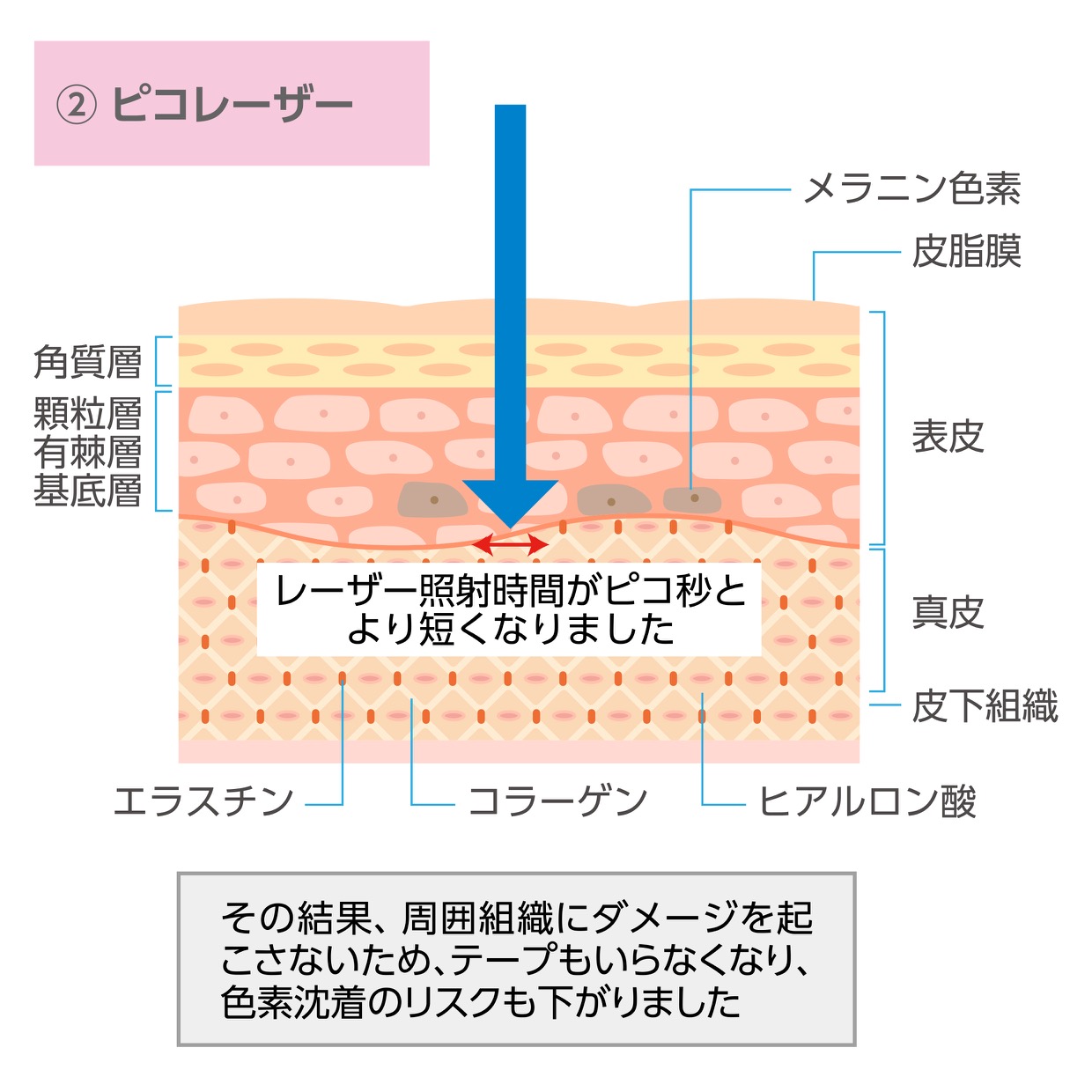 ピコレーザー・エンライトン