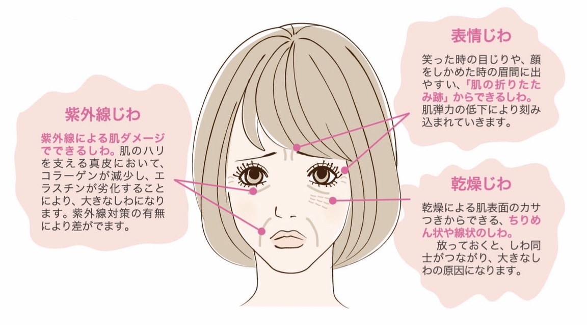 しわの種類