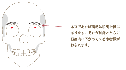 まゆげが下がってしまった場合