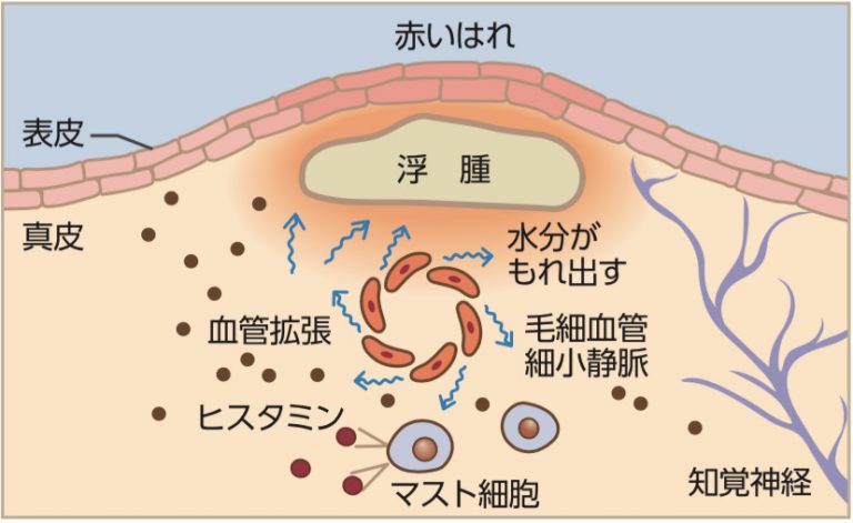 蕁麻疹（じんましん）：大阪心斎橋で手術が保険で出来る【MA皮膚科クリニック心斎橋(女性医師・土日診療 】